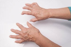Help for Osteoarthritis Pain